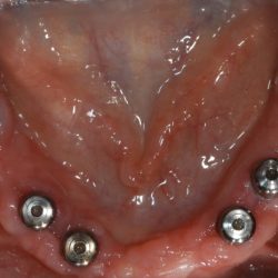 Contraindications indications classification bridge endodontic bridges splint